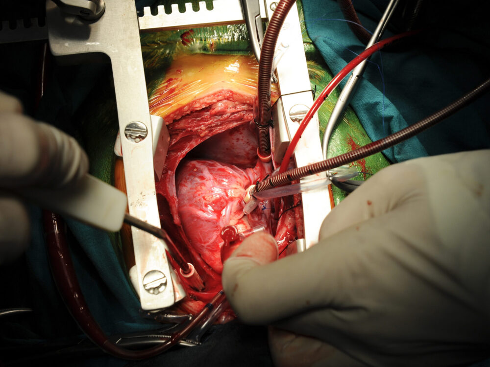 Pediatric heart surgery, close-up